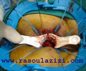 تصويري از عمل جراحي مقعد براي خارج کردن تومور مقعدي